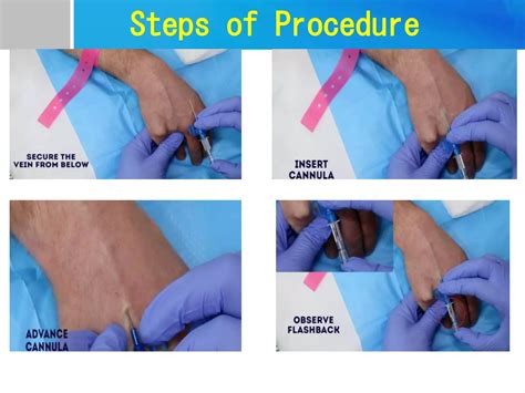 Cannulation procedure steps.  May 6, 2025 · This article provides a comprehensive guide t...