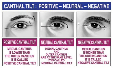 Canthal tilt test. May 16, 2019 · No interventions were conducted for brow positions or canthal tilt. The retrospective evaluation of preoperative photographs revealed brow asymmetry: the left brow was positioned lower than the right brow. Mild blepharoptosis was seen in both eyes: the upper lid covers 2–3 mm of the limbus. A neutral canthal tilt was seen in both eyes. 