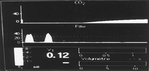 Capnography and Severe COPD : Anesthesia & Analgesia - LWW