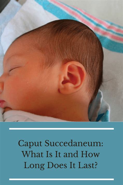 Caput Succedaneum: What It Is, What Causes It, and More - WebMD