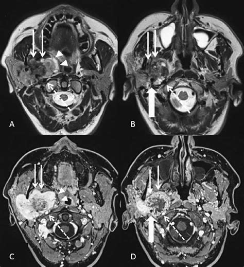 Carcinoma Adenoide Cistico della parotide: l