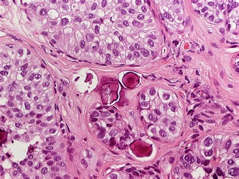 Carcinoma Duttale Infiltrante: cos