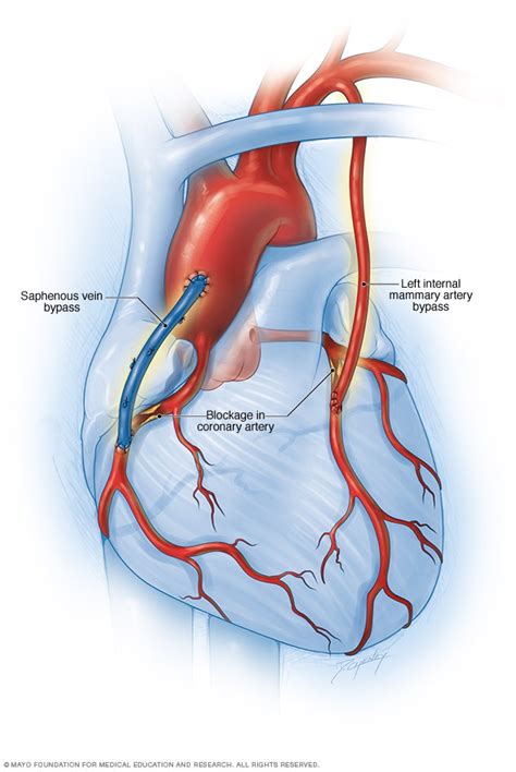 Cardiac CT Angiography After Coronary Bypass Surgery: …