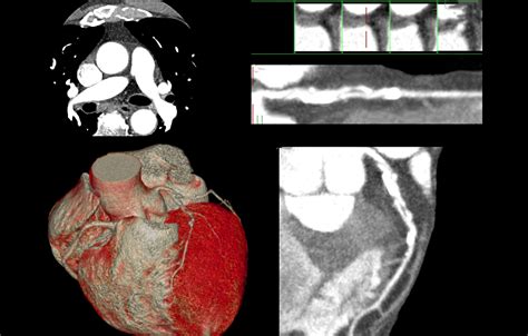 Cardiac CTA - Elite Learning