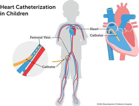 Cardiac Catheterization - Children