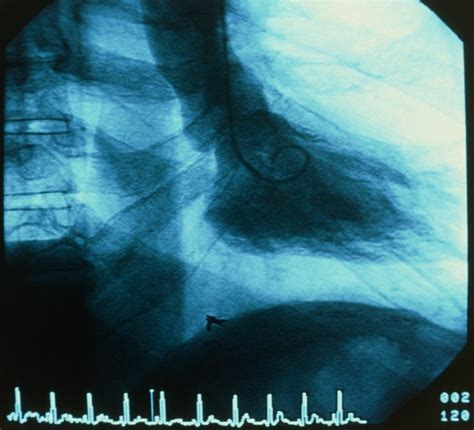 Cardiac Catheterization - Merck Manuals Professional …