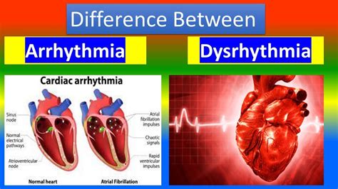 Cardiac dysrhythmias (arrhythmias) (common) - YouTube