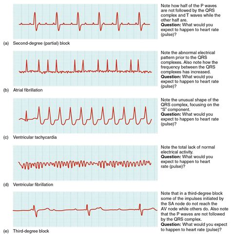 Read Online Cardiac Rhythm Disorders An Introduction Using The Nursing Process Approach By Patricia Lounsbury