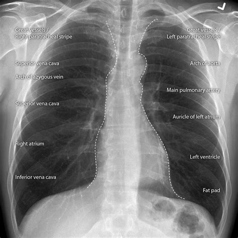 Cardiomediastinal. The cardiomediastinal contour is within normal limits for a supine projection. The lungs and pleural spaces are clear. PA Chest X-ray radiology template report. 