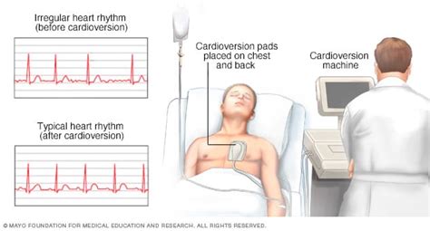 Cardioversion Procedure side effects and recovery
