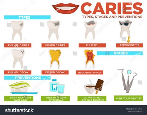 Caries Types Stages and Prevention Poster with Text Vector Stock Vector