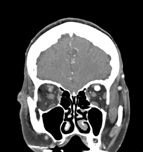 Caroticocavernous fistula Radiology Reference Article - Radiopaedia