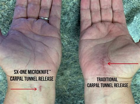 Carpal tunnel release cpt code. The ulnar nerve is decompressed in the wrist through Guyon’s canal and in the hand, specifically the deep motor branch of the ulnar nerve. This deep motor branch is released by dividing the tendious arch of the hypothenar muscles. In addition, a carpal tunnel release is performed by transecting the transverse carpal ligament. Standard 101025 