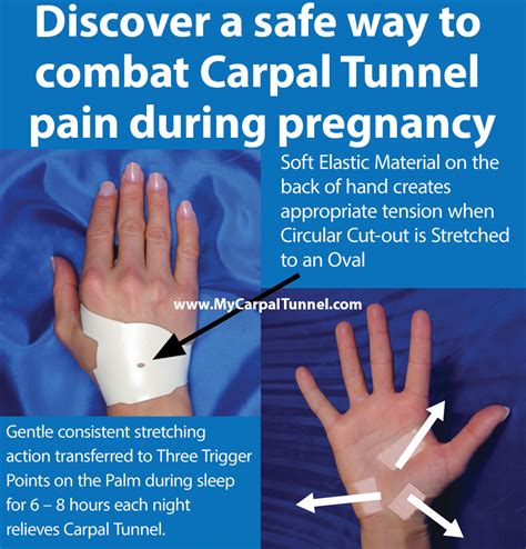 Carpal tunnel syndrome in pregnancy (natural …