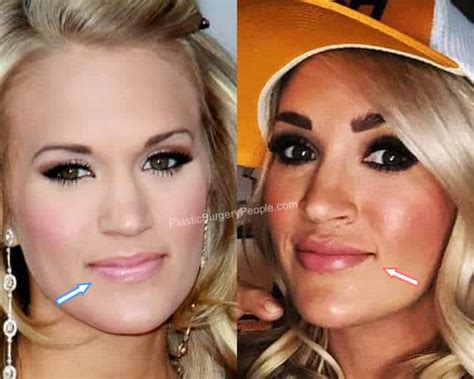 Carrie underwood lip injections. They believed that Carrie Underwood has undergone a face job done. Some of Carrie Underwood’s plastic surgery allegations include a nose job, botox injections, lip fillers, and chin augmentation. Everyone loves before and after images. So let’s closely examine Carrie Underwood’s before and after images to find out the truth. 