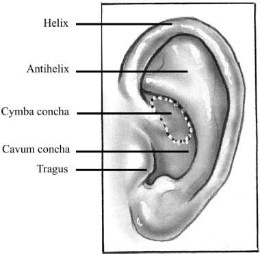 Cartilage Tympanoplasty Ento Key