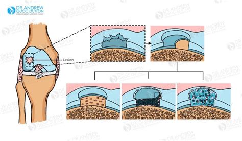 Cartilage repair and regeneration - Nature