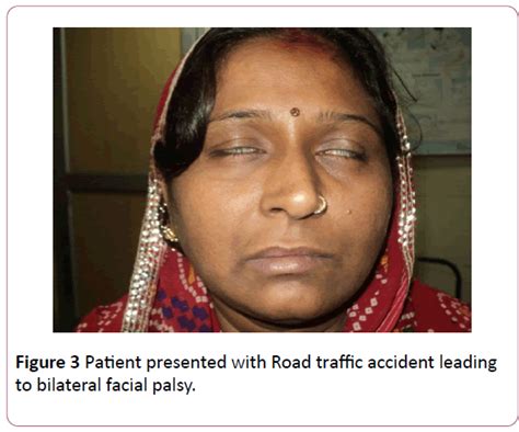 Case of Bilateral Peripheral Facial Nerve Palsy