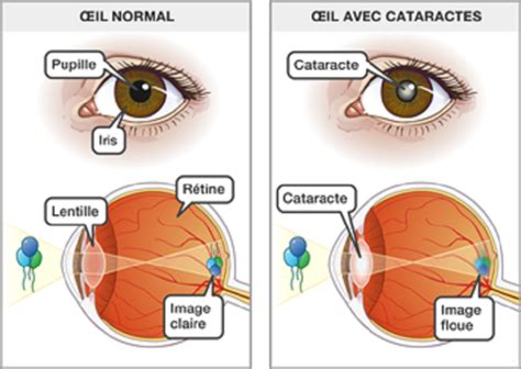 Cataracte - symptômes, causes, traitements et prévention - VIDAL