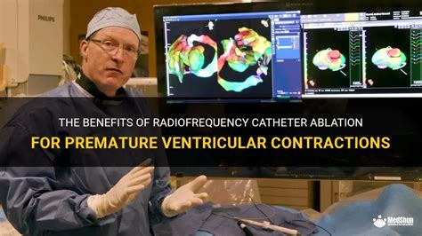 Catheter ablation of premature ventricular complexes …