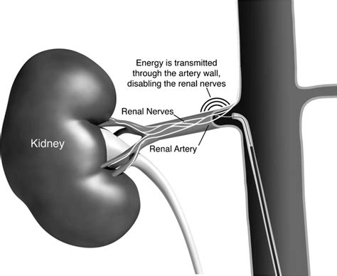 Catheter-based renal denervation for treatment of patients with ...