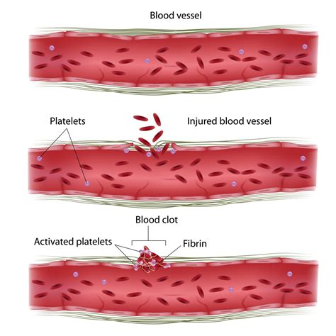 Causes blood clotting problems blood circulation. Medical …