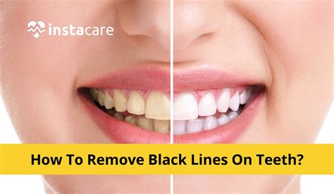 Causes of Black Lines on Teeth: How to Remove Them