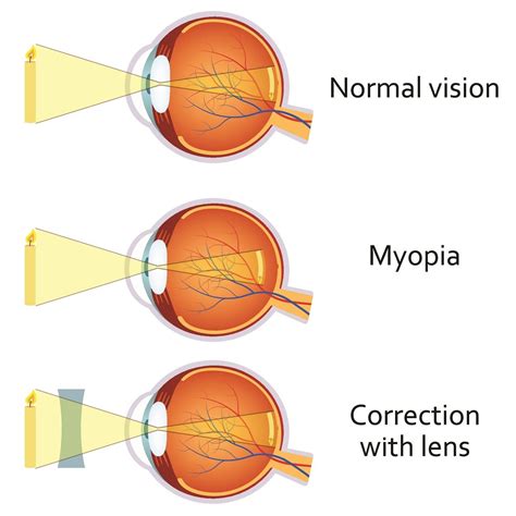 Causes of Myopia EyeQue