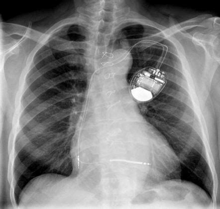 A full range of motion can be recovered in approximately 2 months after fibrosis stabilizes the pacemaker lead. Excessive activity may cause lead to dislodgement. Instruct to avoid shoulder-strap purses, suspenders, or firing rifles resting over the generator site. May promote irritation over implanted generator site.. 