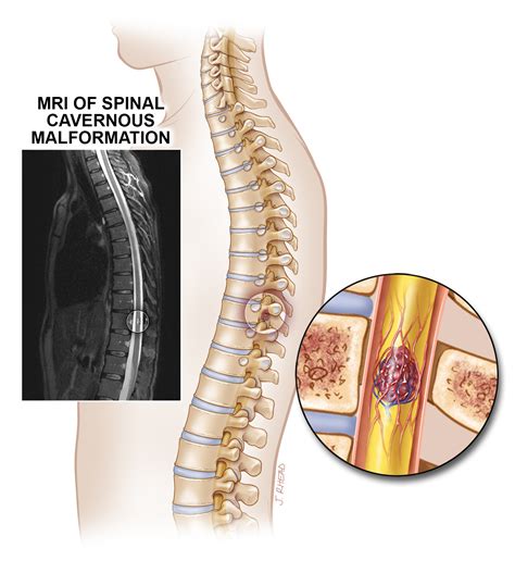 Cavernous Malformation Fast Facts