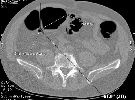 Cecal Mobility: A Potential Pitfall of CT Colonography