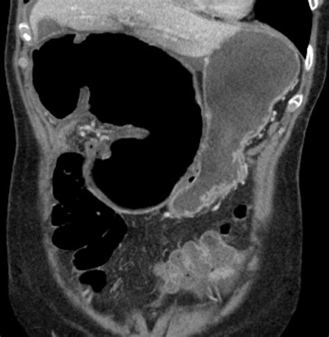 A cecal volvulus is the rotation or torsion of a mobile cecum and ascending colon, which causes approximately 1 to 3 percent of all large bowel obstructions [ 1-3 ]. If untreated, cecal volvulus can progress to bowel ischemia, necrosis, or perforation [ 4-8 ]. The clinical manifestations, diagnosis, and management of cecal volvulus are .... 