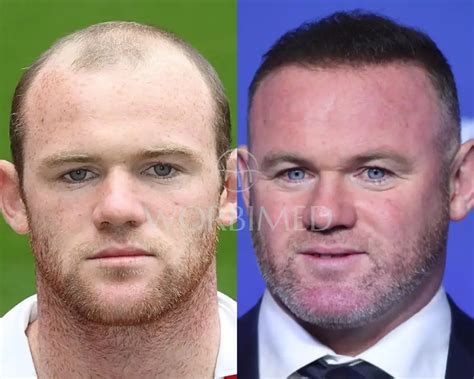 Celeb Hair Transplant Series: Wayne Rooney Before and …