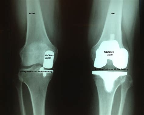 Celebrex prior to surgery June - Joint Replacement Patient Forum