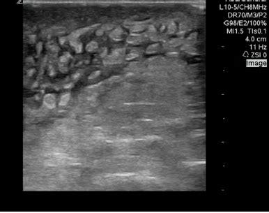 Cellulitis - Appears as "cobblestoning," caused by ... GrepMed