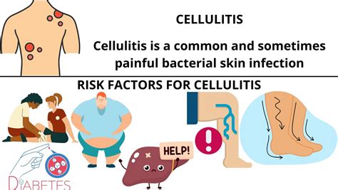 Cellulitis - Symptoms and Causes - University of Pennsylvania Health System