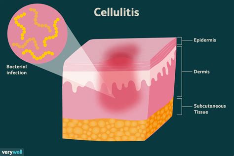 Cellulitis bacteria.  La piel afectada est&aacute; hinchada e inflamada y,...
