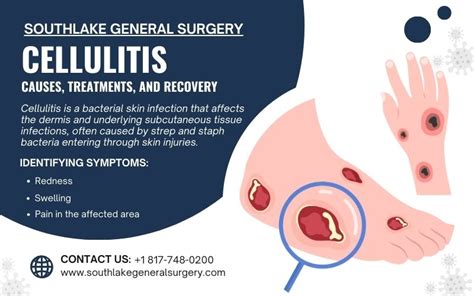 Cellulitis in the Groin Causes Symptoms and Treatment