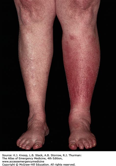Cellulitis of left lower limb icd 10. Things To Know About Cellulitis of left lower limb icd 10. 