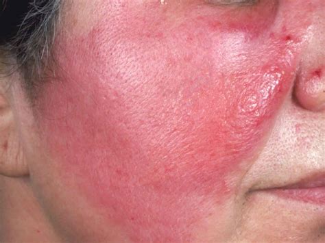 Cellulitis and abscess of face. This ICD-9 code trans