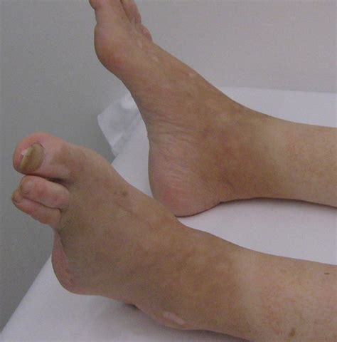 Superficial foreign body in right great toe; Superficial foreign body in right great toe with infection; Superficial foreign body of right great toe; Superficial foreign body of right great toe, with infection. 