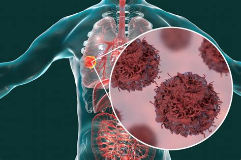 Cemiplimab survival improvements in NSCLC are durable