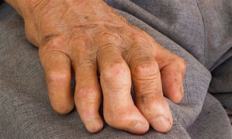 Central Florida is a hot spot for leprosy, report says