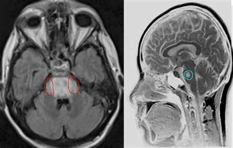 Central Pontine Myelinolysis - StatPearls - NCBI …