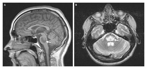 Central Pontine Myelinolysis NEJM