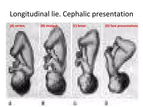 Cephalic presentation and longitudinal lie.  The three main presentations are cephalic (head fir...