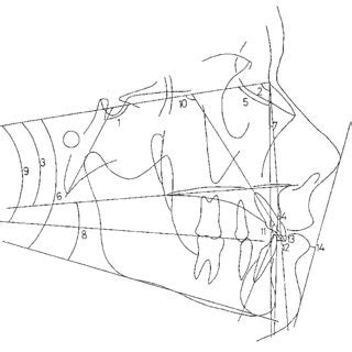 Cephalometric tracing illustrating 11 angular and 3 linear