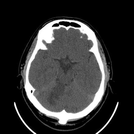 Cerebellar infarction Radiology Reference Article Radiopaedia.org