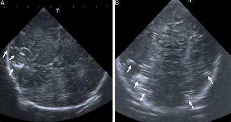 Cerebral air embolism in neonates Anales de Pediatría