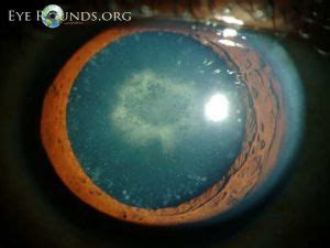 Cerulean Cataract - EyeWiki